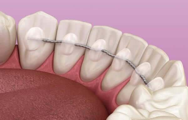 bonded retainer after braces