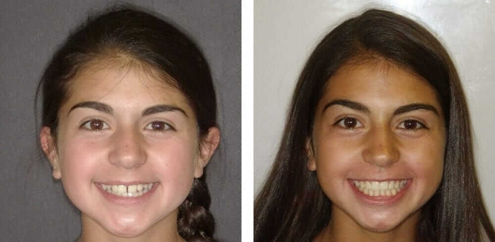 Braces Before and After Pictures with Burke & Redford Orthodontists braces for children temecula ca