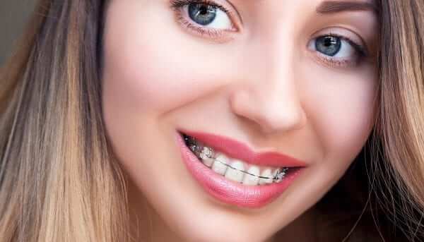 ceramic braces - clear braces