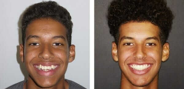 ceramic braces orthodontist