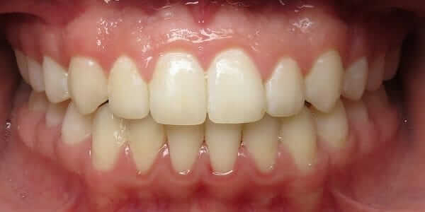 Ceramic Braces - Self Ligating
