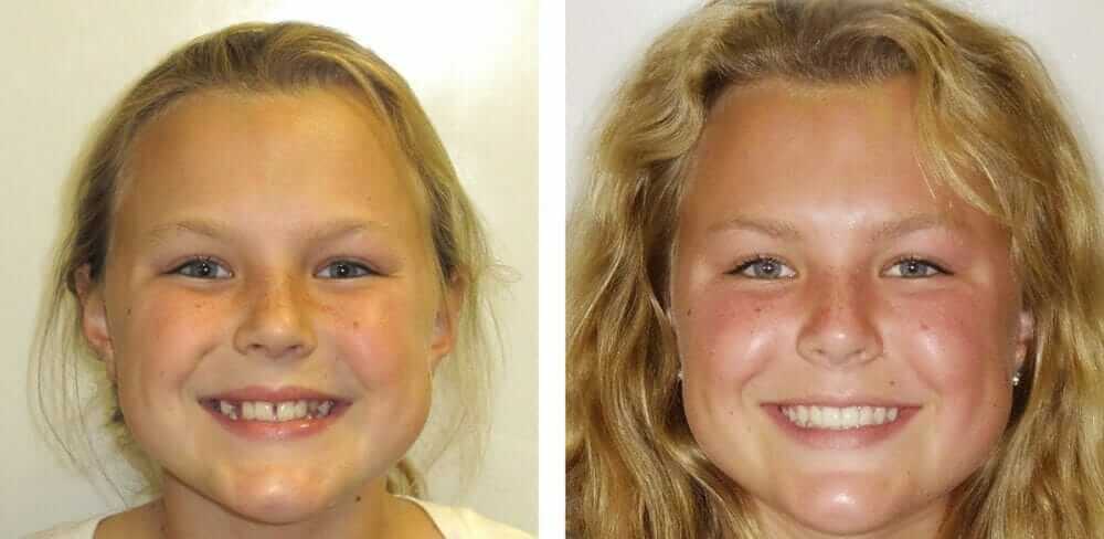 teenager orthodontist in Temecula and Lake Elsinore