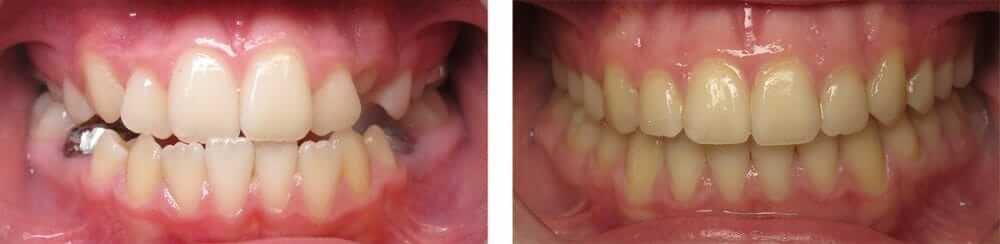 Before and After Bite Correction Using Braces Before and After Bite Correction Using Braces at Burke & Redford Orthodontists