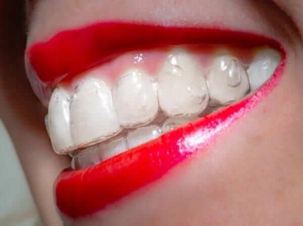 clear invis aligner attachments