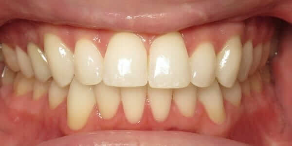 Clear Braces - Ceramic Braces - After Pictures