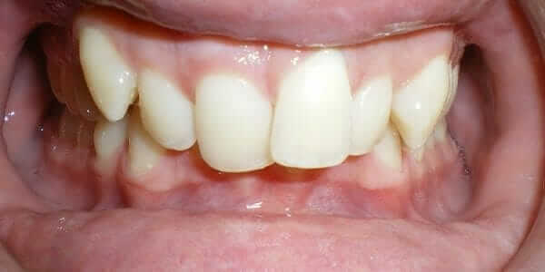 Clear Braces Cost - Before Pictures - Burke Redford Orthodontists