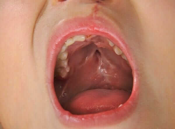 Cleft Palate Surgery Orthodontist Surgeon