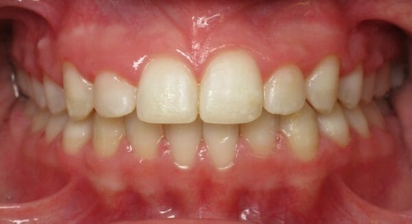 Posterior Crossbite After Picture