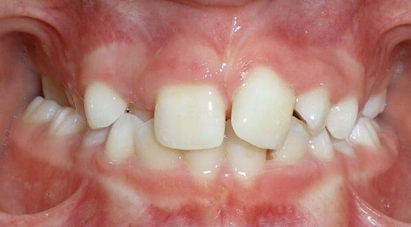 Posterior Crossbite Before Image