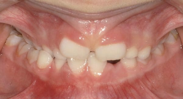posterior crossbite teeth posterior crossbite teeth
