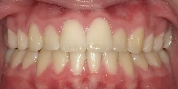 Damon Braces Orthodontic Kids Adults