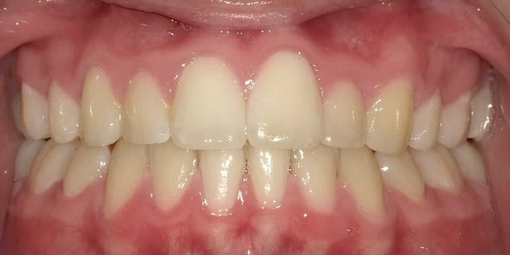 Damon Braces Orthodontic Kids Adults