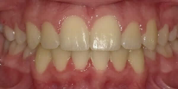 Damon Braces After Picture Damon Braces Before and After Images