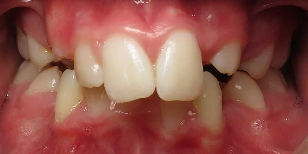 Damon Braces System