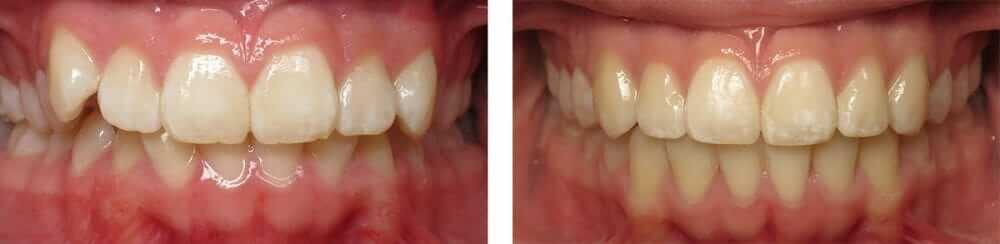 Damon Braces Orthodontist in Temecula and Lake Elsinore