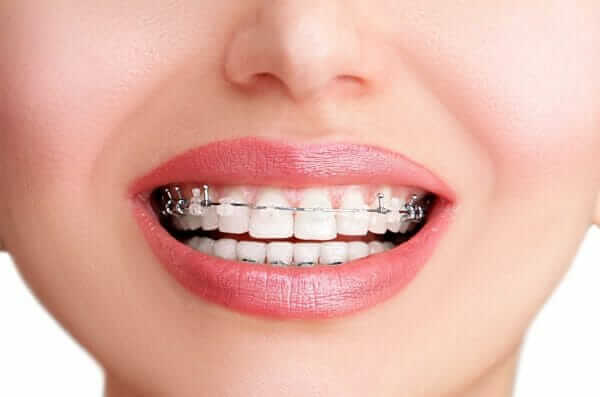 damon clear braces
