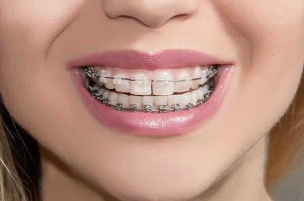 damon metal braces and clear damon braces