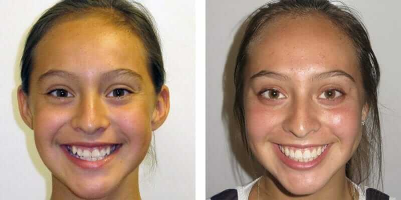 Damon Braces Before and After Photos - Burke & Redford Orthodontists in Temecula and Lake Elsinore, California damon braces orthodontist temecula