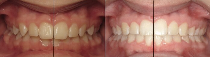 Dental Midline Orthodontist Patient at Burke & Redford Orthodontists Dental Midline Orthodontist