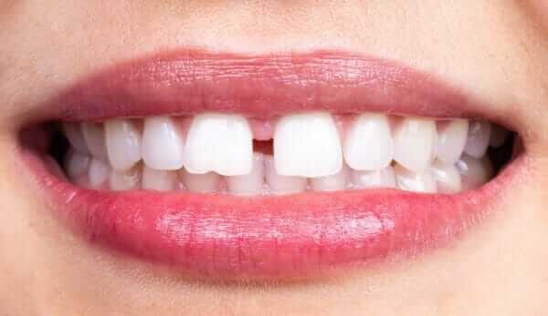 Diastema
