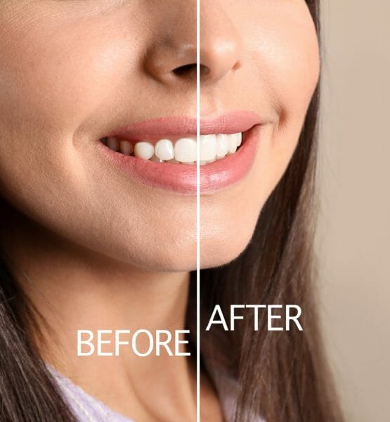 Diode Laser Gum Contouring Before and After Example diode laser gum contouring before and after