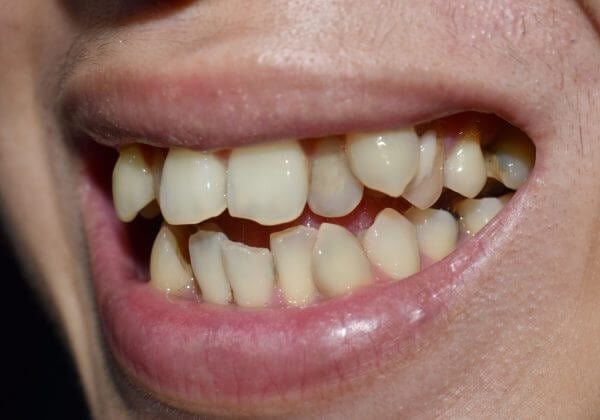 ectopic eruption teeth