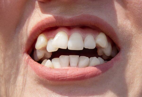 Ectopic Eruption of Teeth without Early Orthodontic Intervention and Treatment