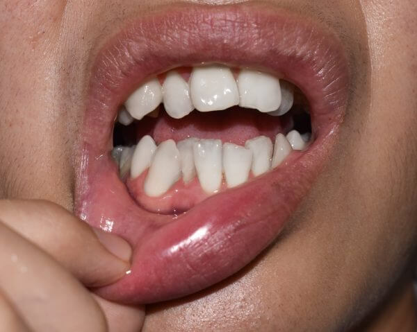 Ectopic Eruption of Teeth without Early Orthodontic Intervention and Treatment