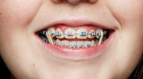 Clear Braces Orthodontist in Temecula and Lake Elsinore Clear Braces Orthodontist in Temecula and Lake Elsinore