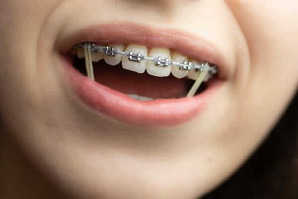 Elastics for Kids Braces elastics for kids braces