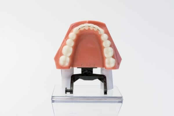 fixed retainers fixed retainers - orthodontist in temecula