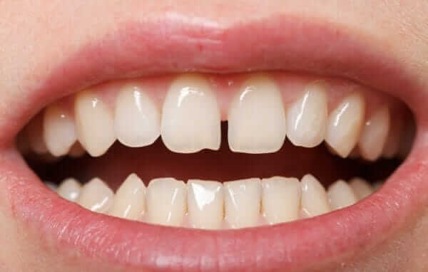 gap teeth