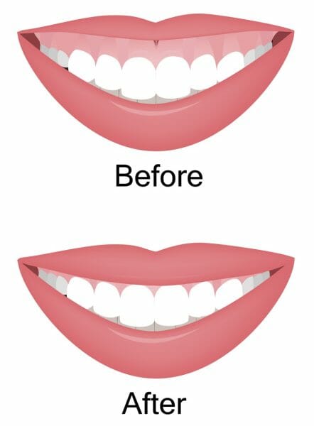 Gummy Smile Before and After Example Gummy Smile Before and After Example