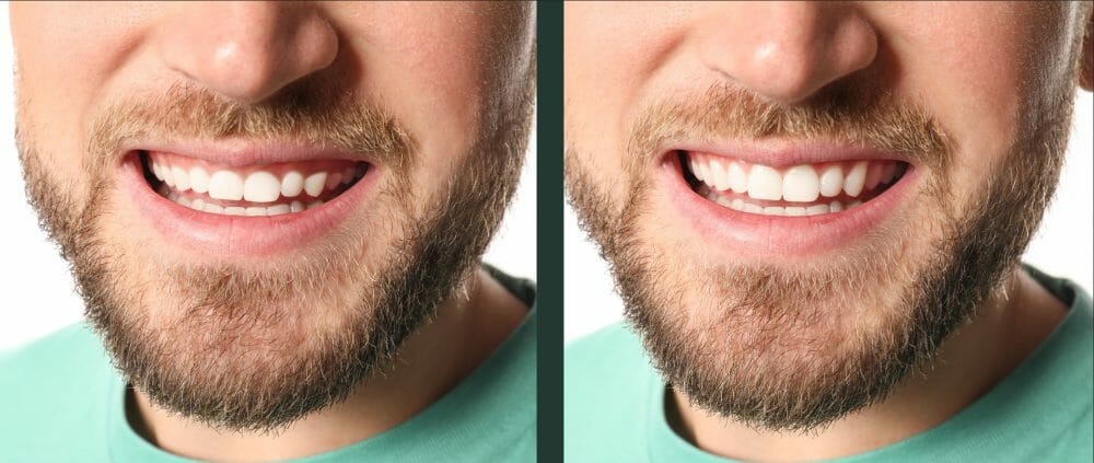 Gummy Smile Can Be Treated with the Diode Laser for Contouring after Braces Gummy Smile Can Be Treated with the Diode Laser for Contouring after Braces