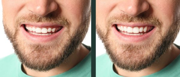 gummy smile treatment Gummy Smile Can Be Treated with the Diode Laser for Contouring after Braces