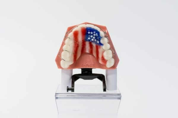 hawyley retainer - burke and redford orthodontists