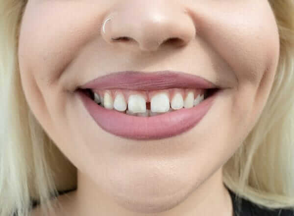 how to fix gap teeth