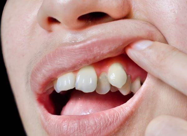 hyperdontia