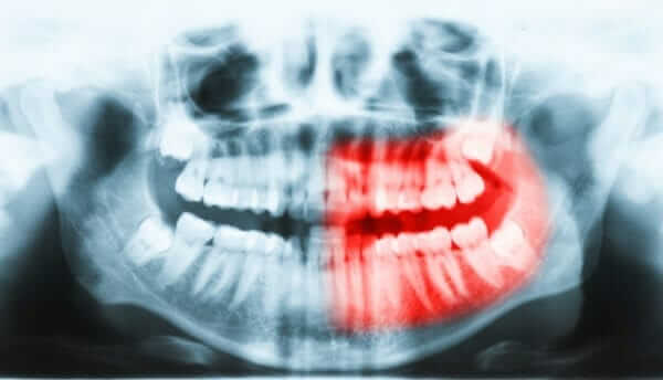 Impacted Teeth