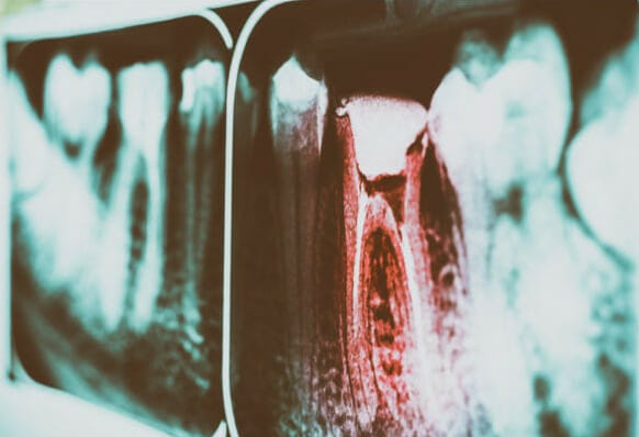 impacted tooth