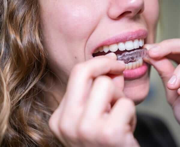 invis clear aligner teenager