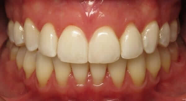 orthodontic treatment for adults Orthodontic Treatment for Adults