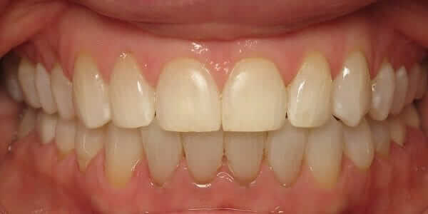 Overbite - Underbite - Invisalign Doctor in Temecula and Lake Elsinore