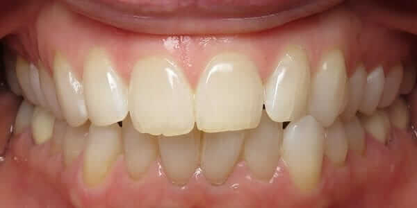 Invisalign Doctor Site in Temecula and Lake Elsinore
