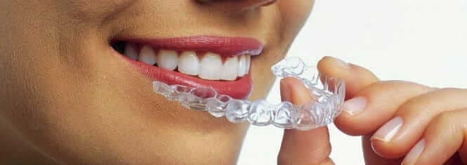 Invisalign for Teens in Temecula and Lake Elsinore Invisalign for Teens in Temecula and Lake Elsinore