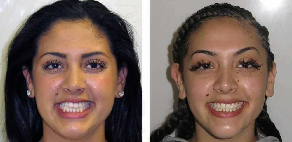 teen braces orthodontist in Temecula and Lake Elsinore