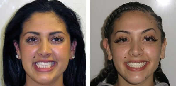 signs your teenager may need braces Here is Another Amazing Before and After Braces Transformation from Dr. Redford & Dr. Burke and Happy Patient!