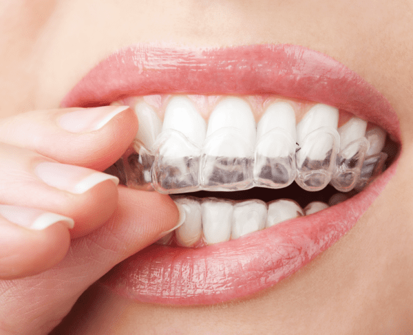 invisalign or braces