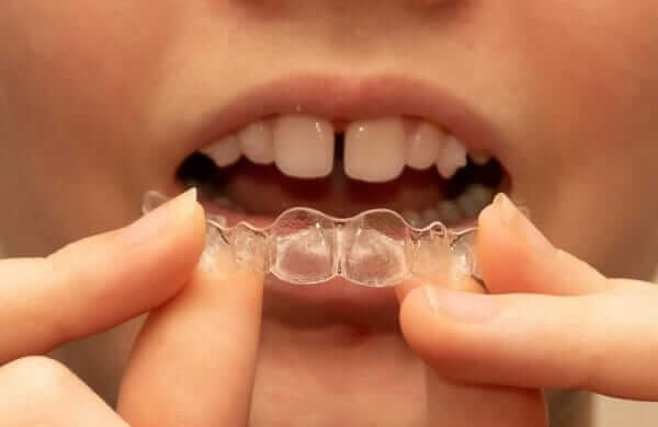 invisalign vs invisalign teen