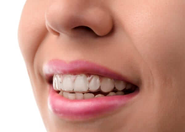 invisible braces invisalign orthodontic temecula invisible braces invisalign orthodontic temecula